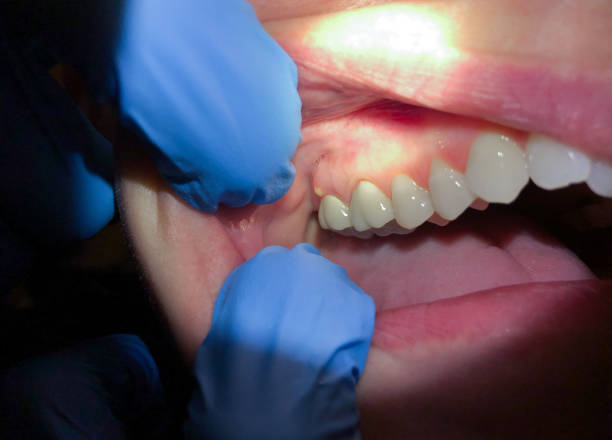 Best Emergency Dentist for Lost Fillings or Crowns in Woodland, WA